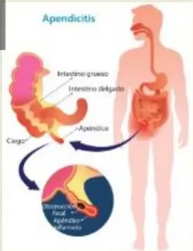 Comparación de sangre normal y sangre con leucemia, con glóbulos blancos aumentados.