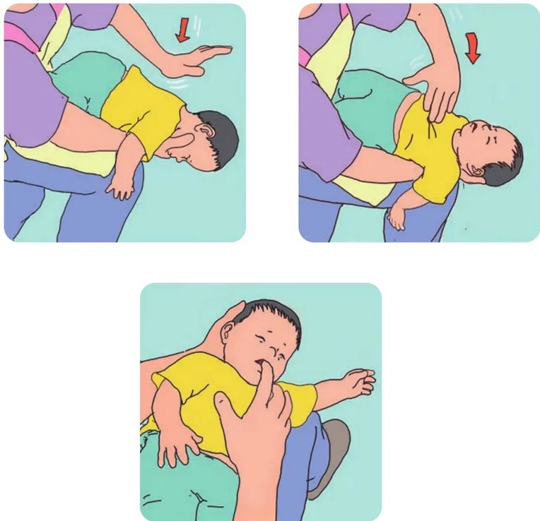 Segunda imagen de golpes interescapulares: misma posición prona sobre el regazo del adulto. Adulto con una mano sosteniendo la cabeza del niño y la otra aplicando golpe en la espalda. Flecha roja indica dirección.