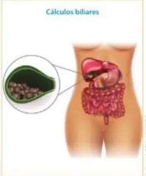 Comparación entre amígdalas normales y amígdalas inflamadas.